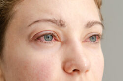 Women with bloodshot eyes after smoking marijuana